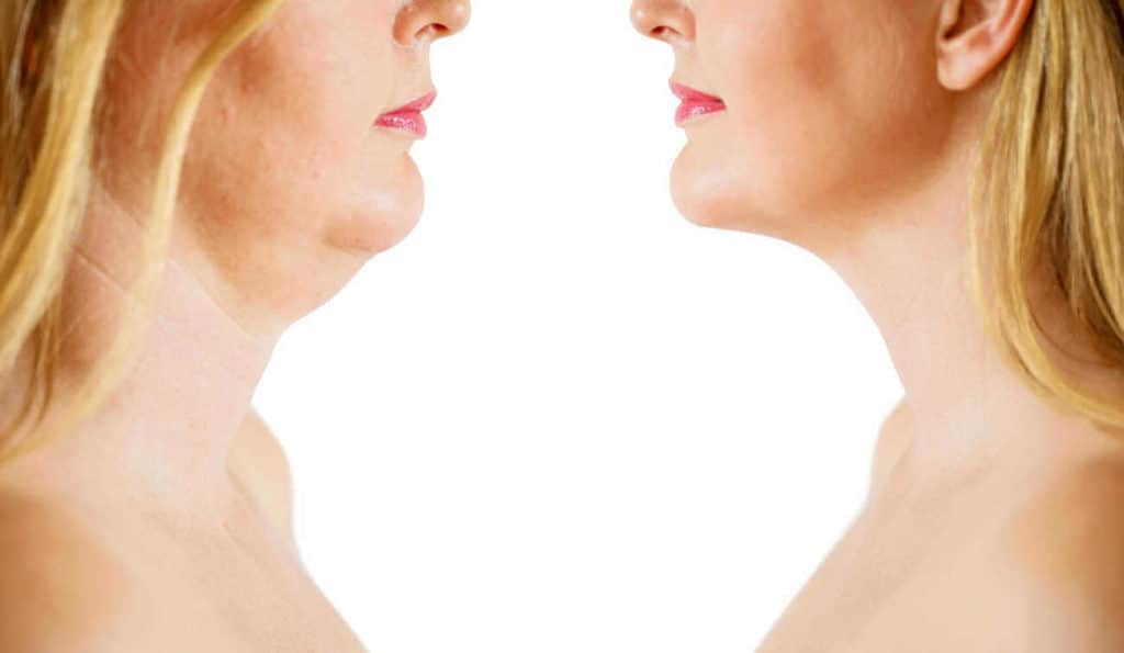 Double Chin treatment Felixstowe before and after results
