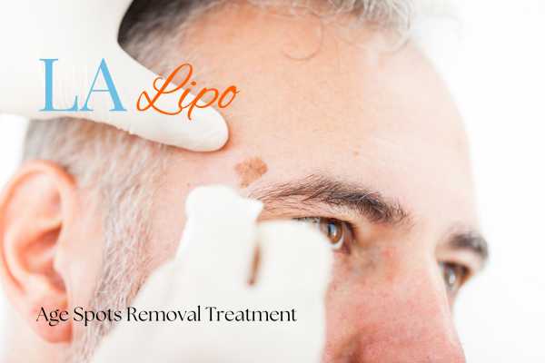 What Are the Most Effective Treatments for Age Spots Felixstowe?