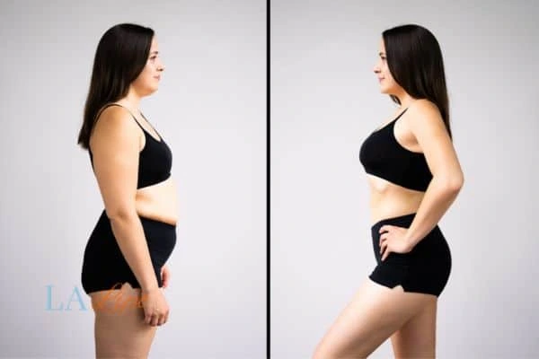 image of woman before and after results of LA-EMS Body Sculpting Felixstowe to help treat Diastasis recti