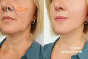 hi-fu for wrinkles Felixstowe before and after results