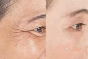 Before and after results of woman - HI-fu wrinkles reduction treatment Felixstowe