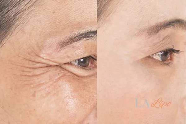 Before and after results of woman - HI-fu wrinkles reduction treatment Felixstowe