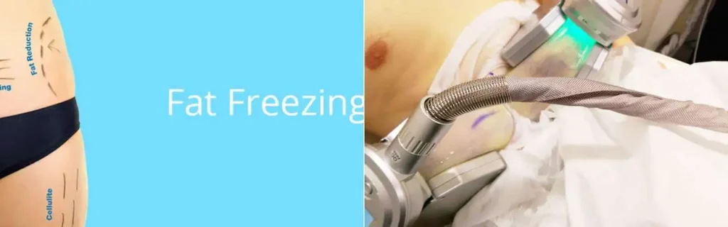 Fat freezing Felixstowe on multiple areas of the body