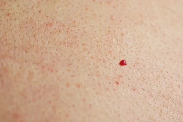 close up of a cherry angioma Felixstowe