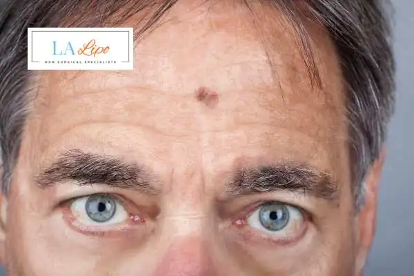 Solar Lentigo Removal Felixstowe image of man with mark on his forehead