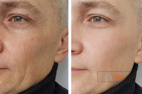 See the amazing results of Morpheus8 Treatment Felixstowe!
