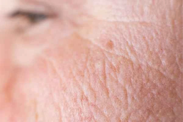close up picture of a woman's face showing an age spot Felixstowe