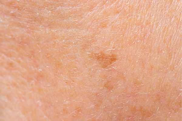 close up picture of age spots Felixstowe