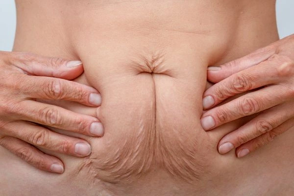 Should I Combine Diastasis Recti Treatment with Body Contouring for Better Results Felixstowe?