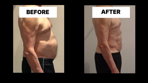 What Symptoms Can Diastasis Recti Cause in Men? Weak Core, Back Pain and Poor Posture Felixstowe
